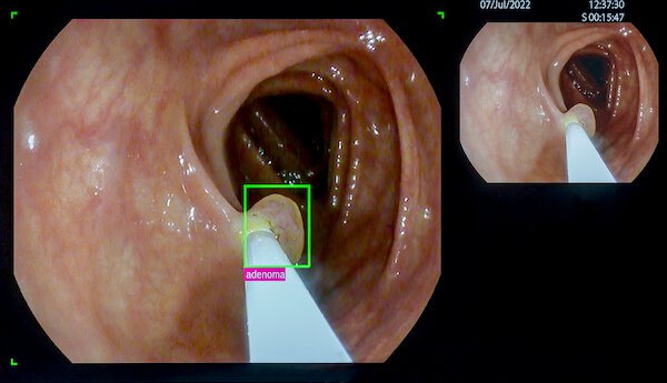 Kleines Adenom im proximalen Colon. Der Polyp wird durch das KI-System in Echtzeit auf dem Monitor mit einem grünen Rahmen gekennzeichnet.